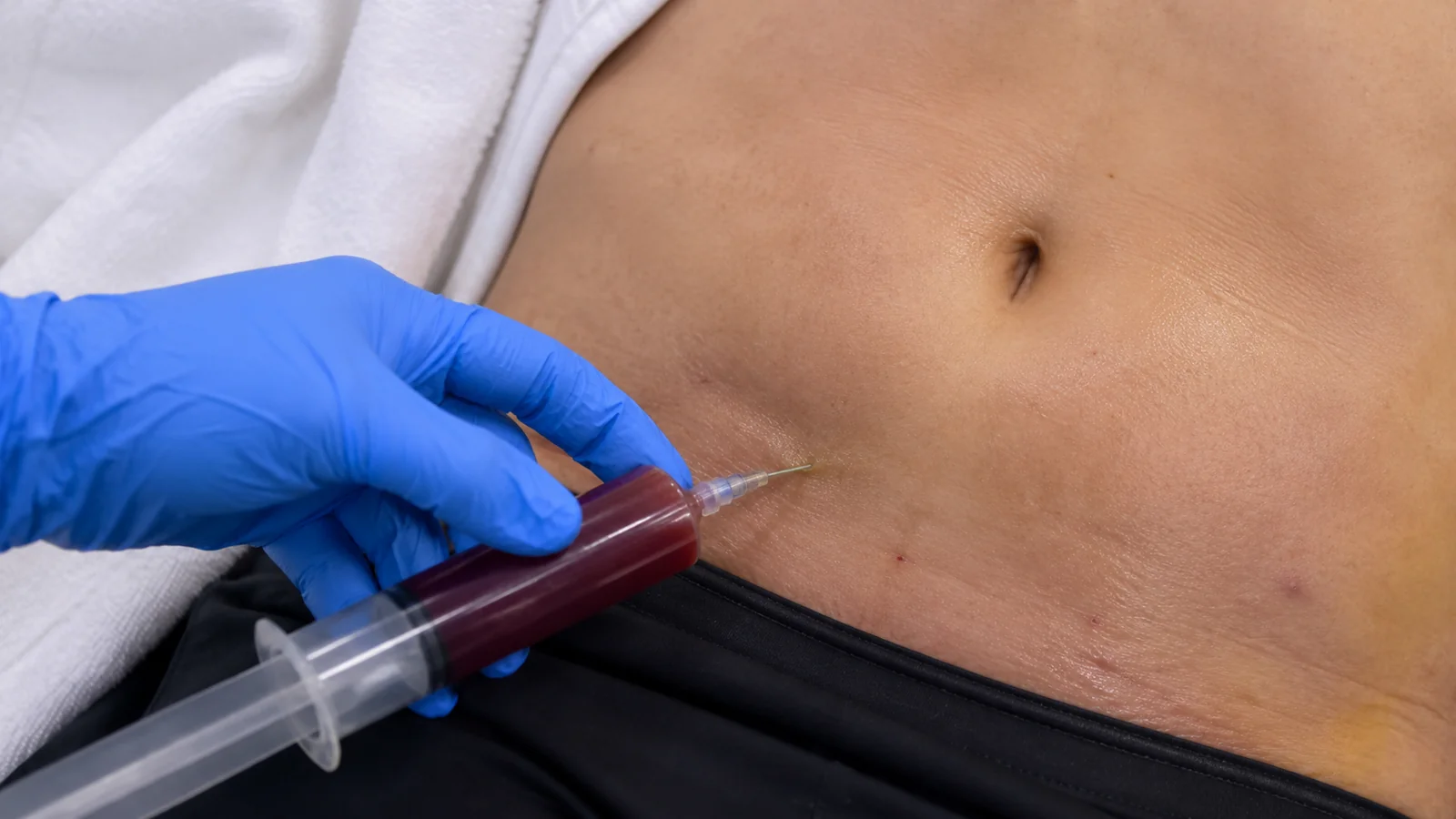 Drenagem de líquido no pós-operatório com seringa em região abdominal