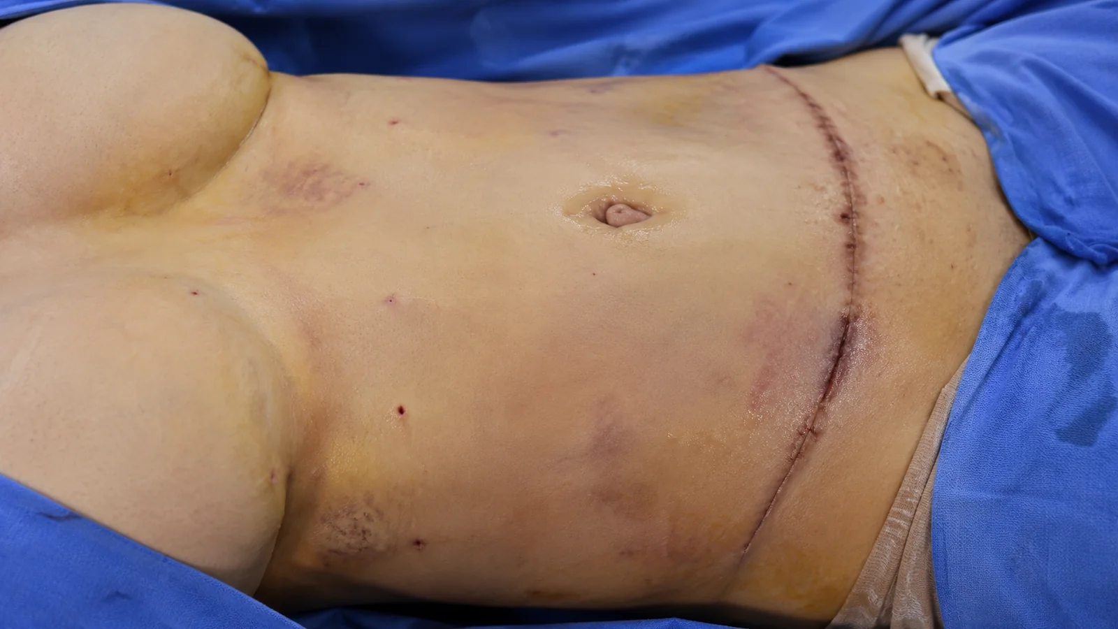 Abdômen em pós-operatório inicial de lipo com edema, hematomas e sinais de recuperação