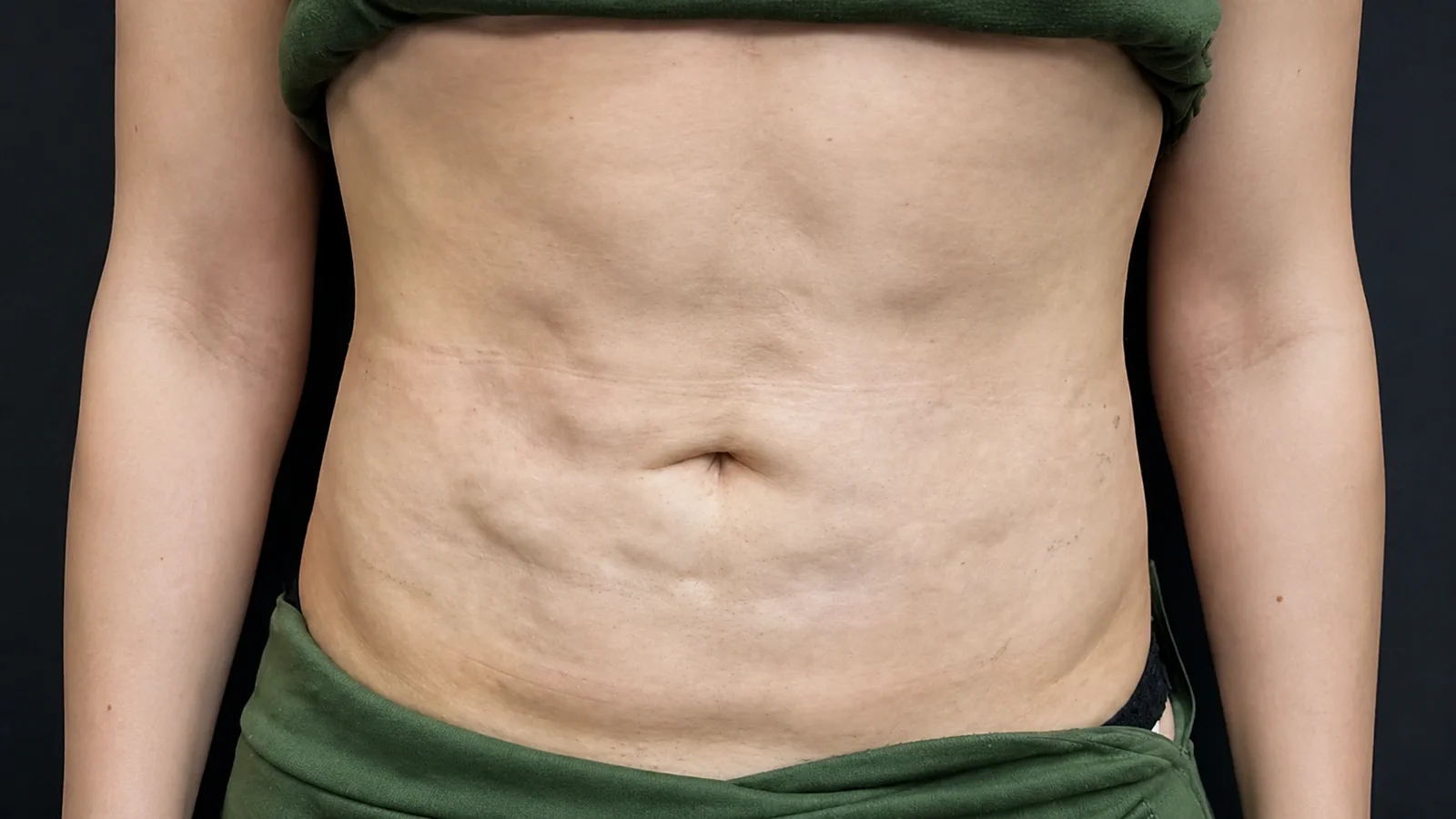Abdômen com fibrose e irregularidades após cirurgia plástica
