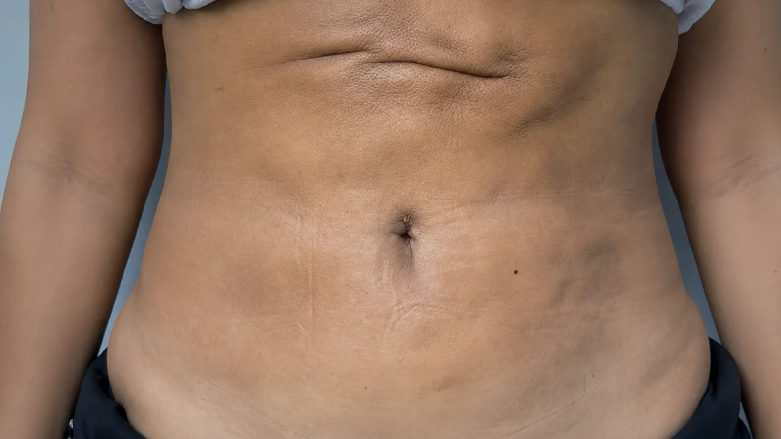 Pós-operatório tardio com fibrose, aderências e irregularidades no abdômen