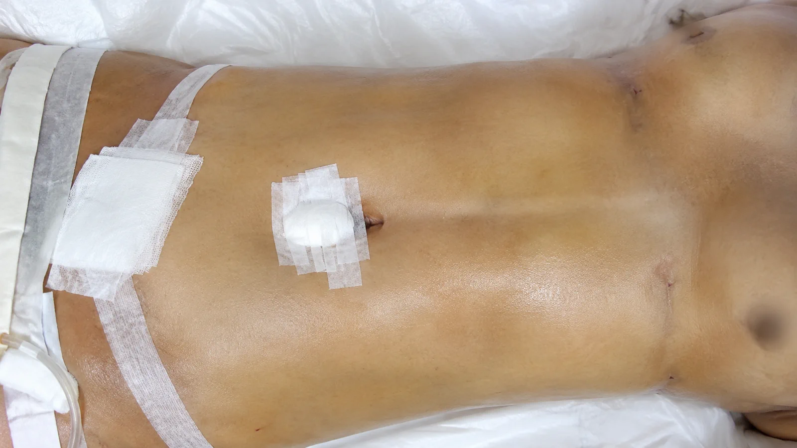 Abdômen em pós-operatório recente com curativos e sinais de recuperação